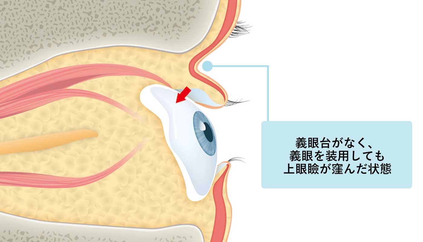 義眼